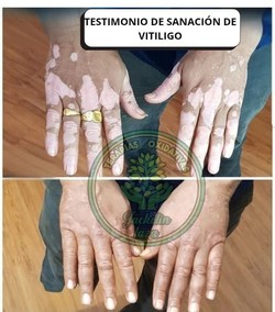 File:Vitiligo Laura Martinez Before After.jpg
