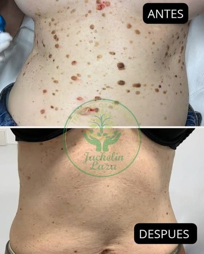 File:Seborrheic Keratoses Before After Dr Laza.jpg