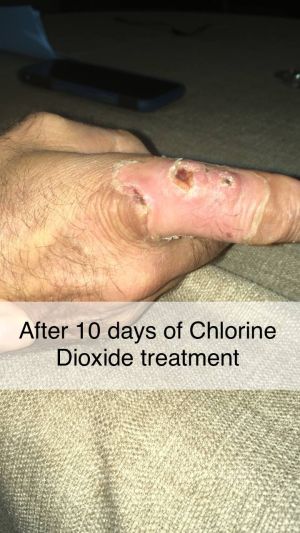 Rheumatoid Arthritis 10days.jpg