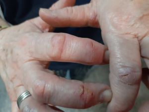 Wounds CDS Protocol D 07.jpg