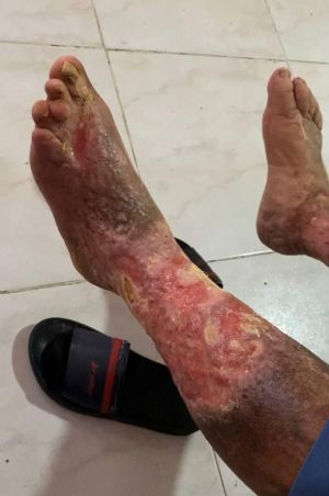 Post Thrombotic 76yo 02.jpg