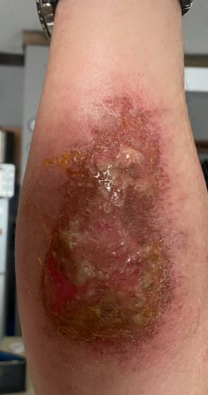 Brown Recluse Metal Implants 05.jpg