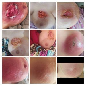 Case study breast cancer treat 1.jpg