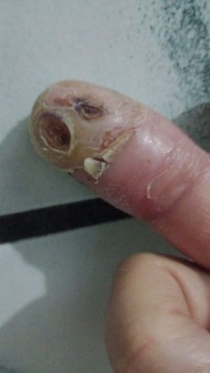 DiabeticFinger Process 01.jpg