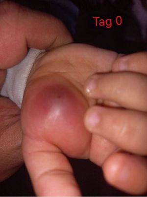 Case study toddler hand infect 1.jpg