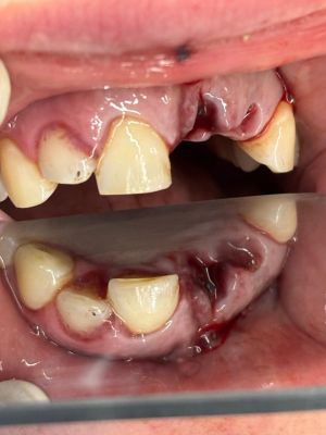 Dental Reimplant Trauma 10.jpg