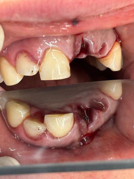 File:Dental Reimplant Trauma 10.jpg