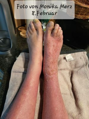 Cousin Insect Bite img 2ed9cee910e6.jpg