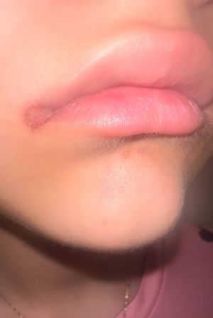 Case study hpv papilloma at li 2.jpg