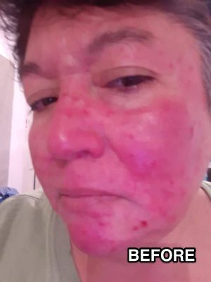 Cousin Insect Bite img bb51abd5053d.jpg