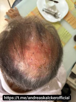 Dr Hernan Squamous Cell Cancer 03.jpg
