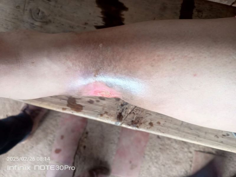 File:Wound Polimicrobial 2.jpg