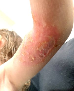 Case study childs burned arm h 1.jpg