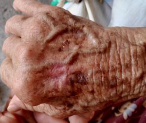 Case study skin cancer in elde 3.jpg