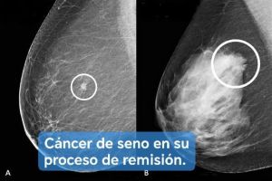 Breast Cancer Mammography JM.jpg