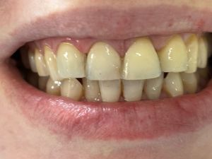 Dental Reimplant Trauma 2.jpg