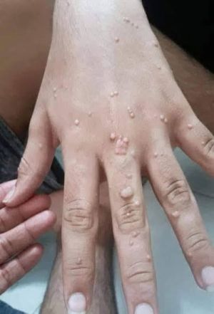 Teen Warts CDS 02.jpg
