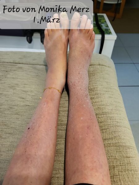 File:Cousin Insect Bite img 39eefaea1d07.jpg