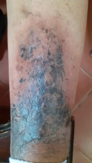 Varicose Ulcers Advanced 02.jpg