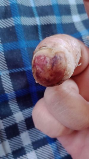 DiabeticFinger Process 08.jpg