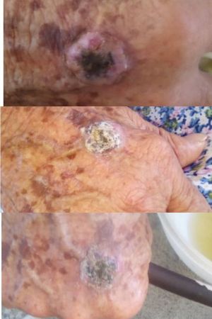 Case study skin cancer in elde 1.jpg