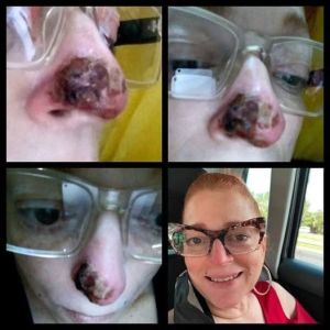 Nose Carcinomas CDS 2022.jpg