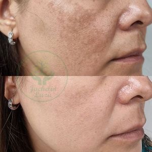 Testimonial Melasma Cleared with Integrative CDS Protocol 1.jpg