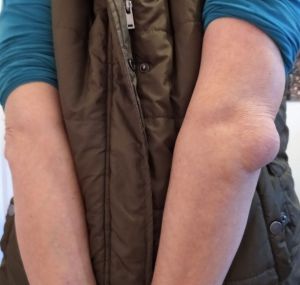 Case study bursitis resolved i 1.jpg