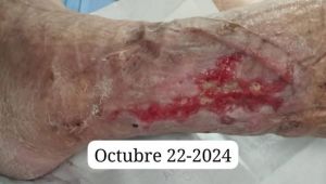 Diabetic Non Healing Wound CDS DMSO Moringa 03.jpg