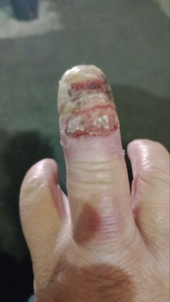 File:DiabeticFinger 1.jpg