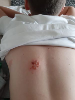 Case study herpes on childs ba 1.jpg