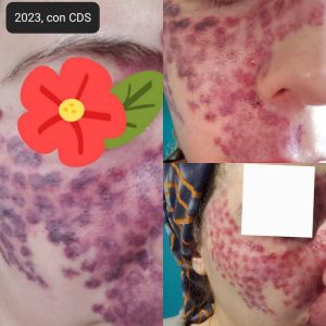 Case study hemangioma laser re 2.jpg