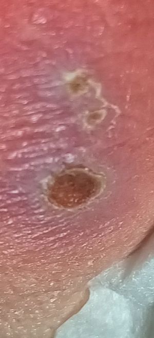 Case study diabetic decubitus 4.jpg