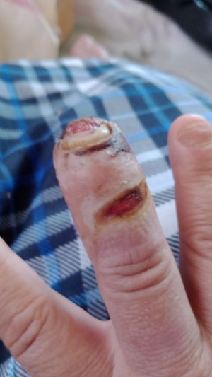 DiabeticFinger After 03.jpg