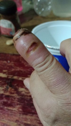 DiabeticFinger Process 05.jpg