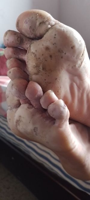 Case study fungal foot infecti 1.jpg