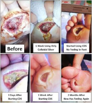 Diabetic Foot Ulcer Neuropathy.jpg