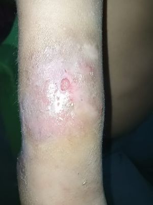 Case study severe osteomyeliti 5.jpg