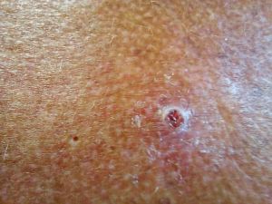 Basal Cell Carcinoma Before 02.jpg