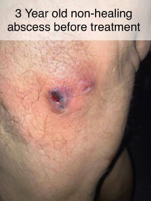 Child Abscess 3Year.jpg
