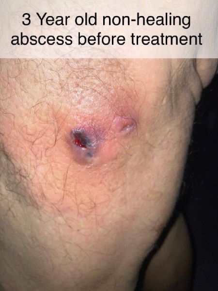 File:Child Abscess 3Year.jpg