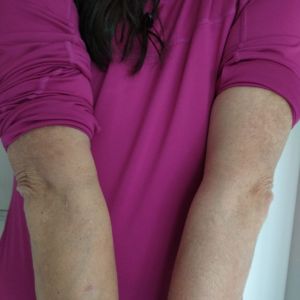 Case study bursitis resolved i 2.jpg