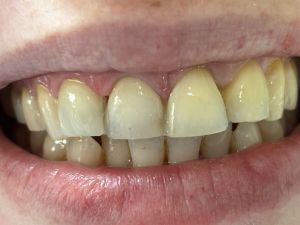 Dental Reimplant Trauma 1.jpg