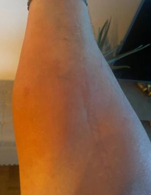 Brown Recluse Metal Implants 06.jpg