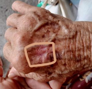 Case study skin cancer in elde 2.jpg