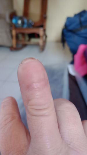 DiabeticFinger Process 16.jpg