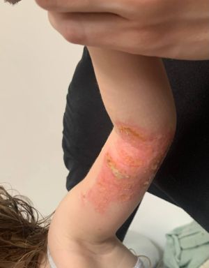 Case study childs burned arm h 2.jpg