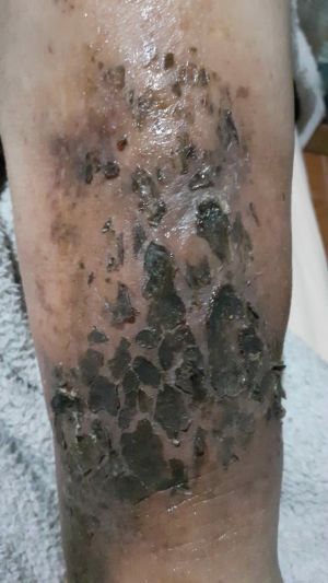 Varicose Ulcers Advanced 03.jpg