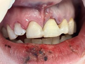 Dental Reimplant Trauma 8.jpg