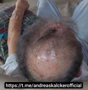 Dr Hernan Squamous Cell Cancer 01.jpg
